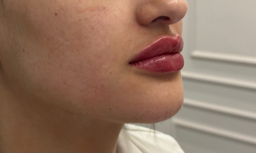 Resultado de preenchimento labial