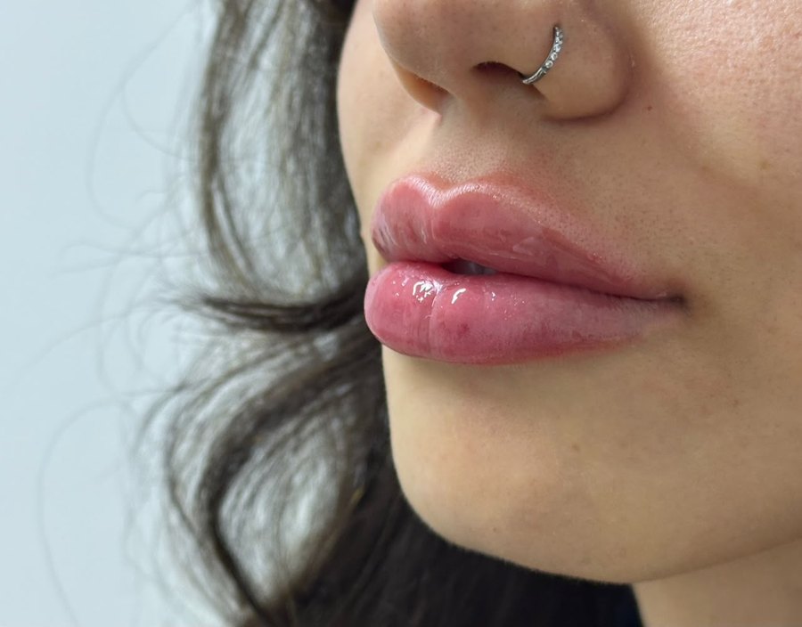 Resultado de preenchimento labial, lábios de perfil