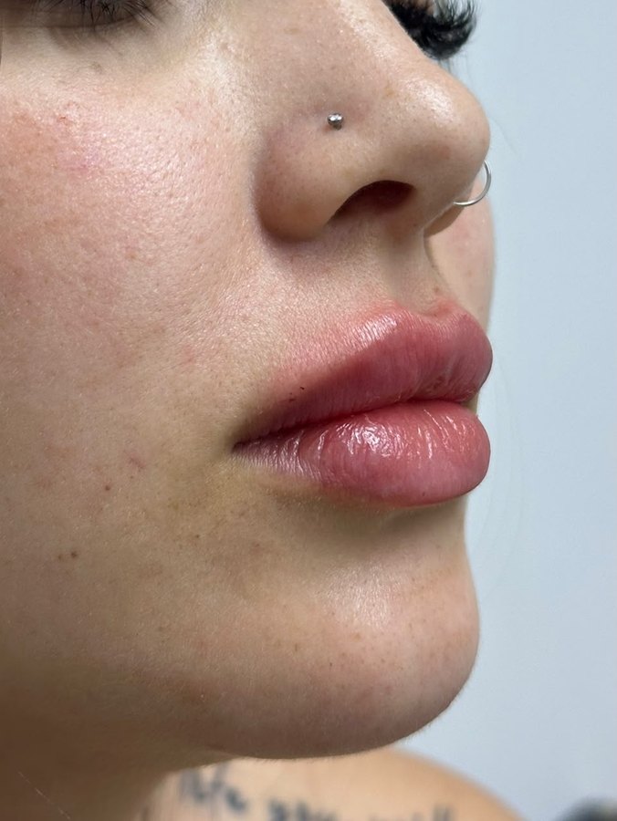 Resultado de preenchimento labial, close lateral dos lábios