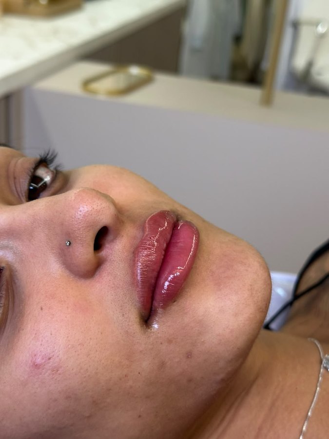 Resultado de preenchimento labial em close